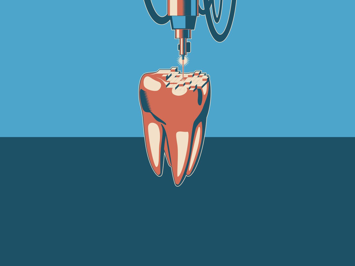 Illustration eines Zahns der von einem 3D-Drucker digital gescannt wird